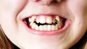 Crooked Teeth Treatment in Gurgaon