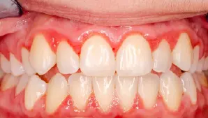 Gingivitis Gum Disease