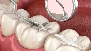 Sealing the Tooth Process