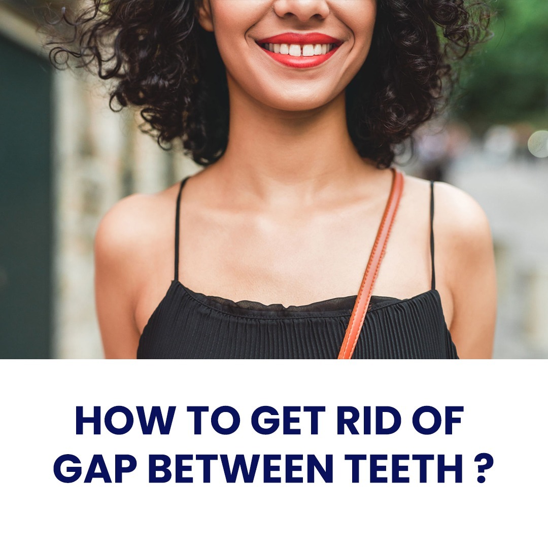 how-to-get-rid-of-gap-between-teeth